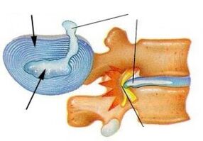 Destrución do anel fibroso con osteocondrose cervical